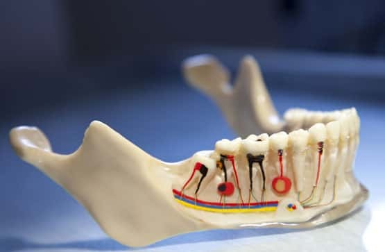 Root canal Treatment in Singanallur