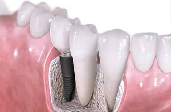 Dental Implant Treatment in Singanallur