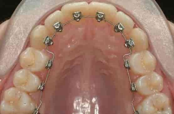 orthodontic Treatment in Racecourse