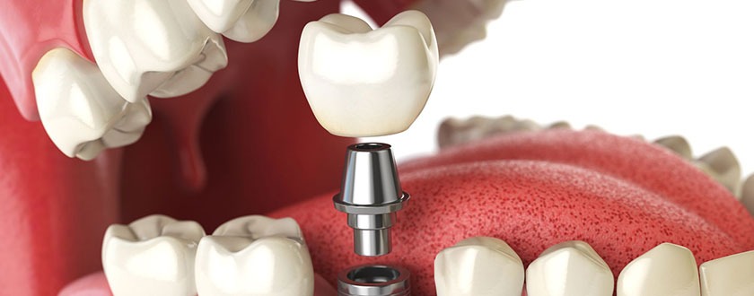 Dental Implants Treatment in Coimbatore