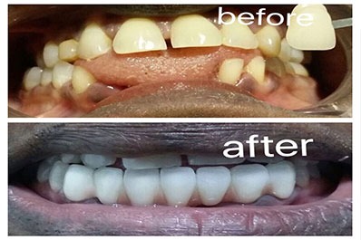 teeth treatment in coimbatore