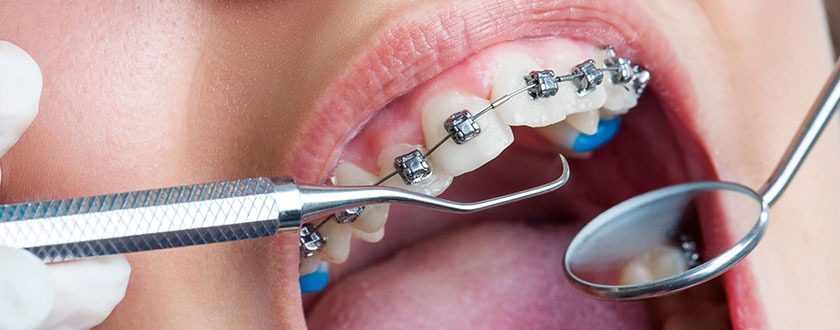 Orthodontic (Clip) Treatment in Ramanathapuram