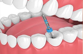Preventive dentistry in coimbatore