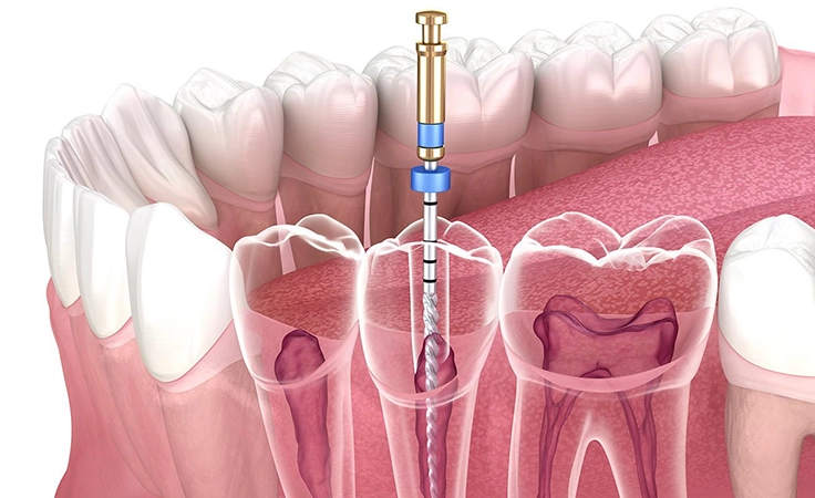 Get expert root canal treatment in Ramanathapuram, Coimbatore with safe, painless dental care services.