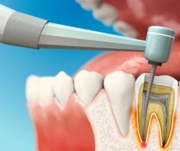 During a dental check, the patient performs a procedure on a tooth for root canal treatments.